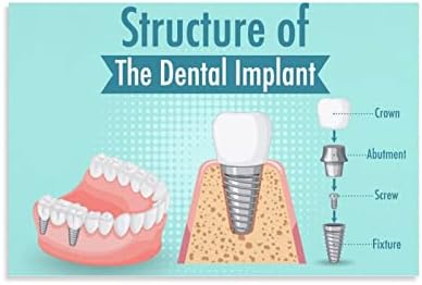 Bludug Dental Implant Dental Care Poster Dental Clinic Poster Pintura de Canvas Posters e Impressões de Arte da parede Fotos para