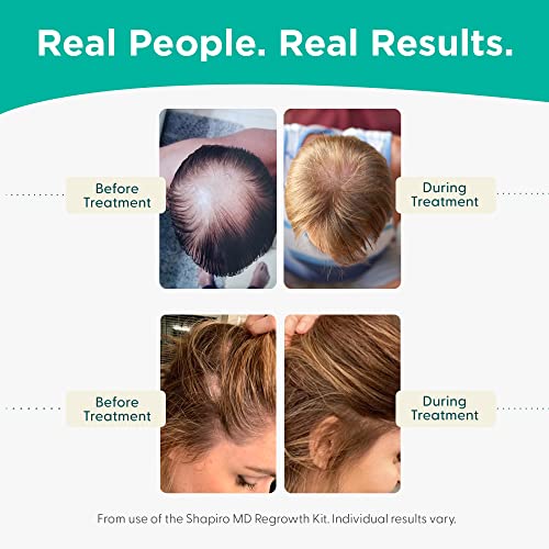 Shampoo e condicionador de perda de cabelo | DHT Formula vegana de combate a um cabelo de afinação desenvolvido por dermatologistas | Experimente cabelos mais saudáveis, mais cheios e mais grossos - Shapiro MD | Fornecimento de 2 meses