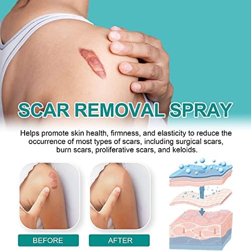 Cicatriz remover spray avançado de cicatriz, scarremove spray avançado para todos os tipos de cicatrizes, cicatriz remover spray de cicatriz de grau médico