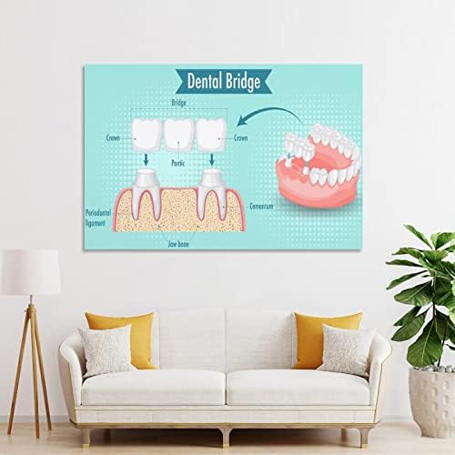 Dental Bridge Poster Dental Implant Poster Posters dentários Posters de pintura de lona e impressões imagens de arte de