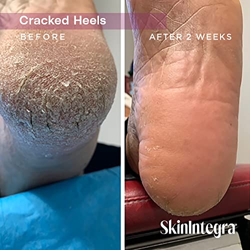 SkinIntegra Rapid Crack Repair creme de pé, creme de uréia de força extra 25% mais ácido lático promove reparo de salto rachado e hidrata e nutre a pele seca com ácidos graxos ômega em 1 dia